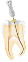 Endodontie in der Zahnarztpraxis Dr. Eichinger, Würzburg