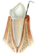 Grafik Gingivitis