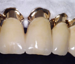 Zahnersatz in der Zahnarztpraxis Dr. Eichinger, Würzburg